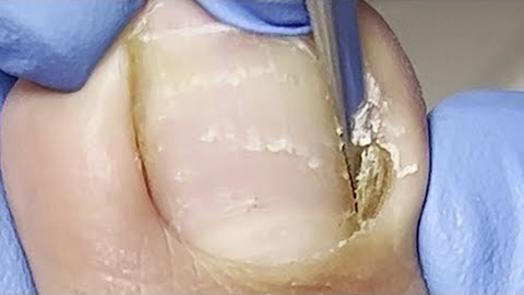 Ingrown at the base of the toenail, very deep【Xue Yidao】