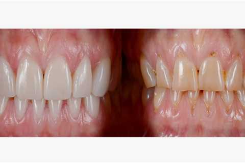 What is Veneers in Dentistry